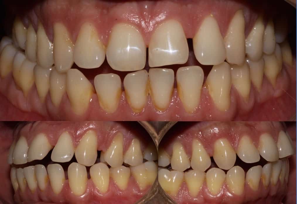 Ortodontia Damon System 138