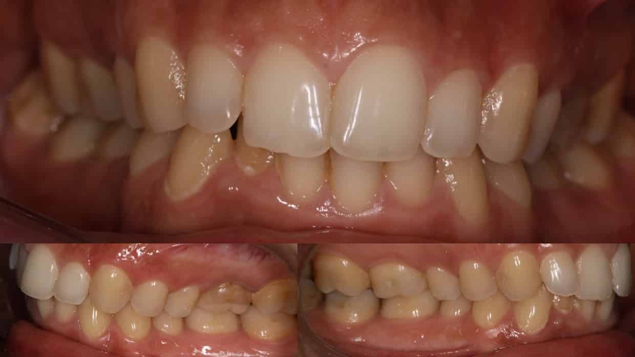 Ortodontia Damon System 140