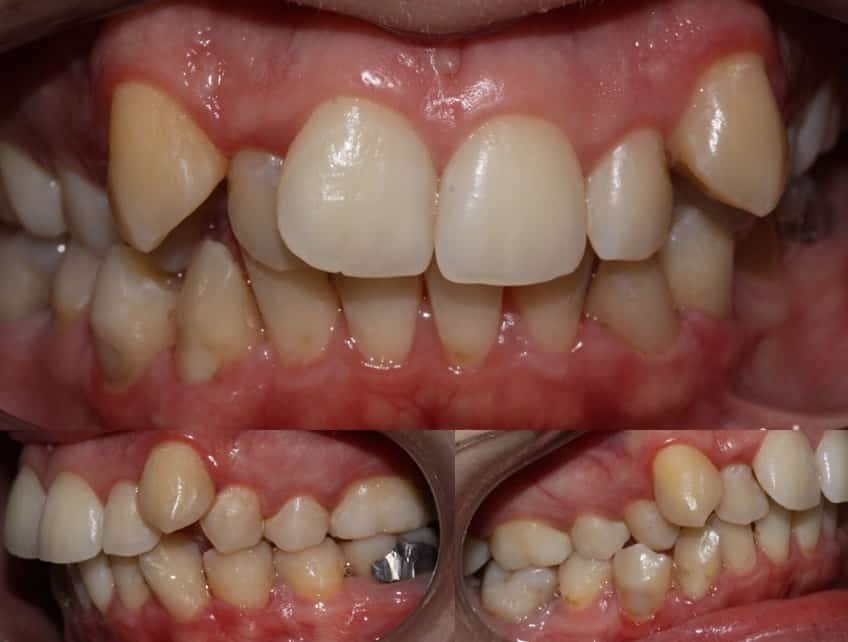 Ortodontia Damon System 144