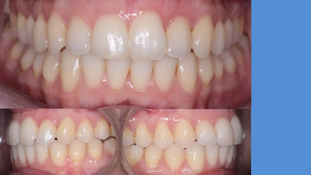 Ortodontia Damon System 149