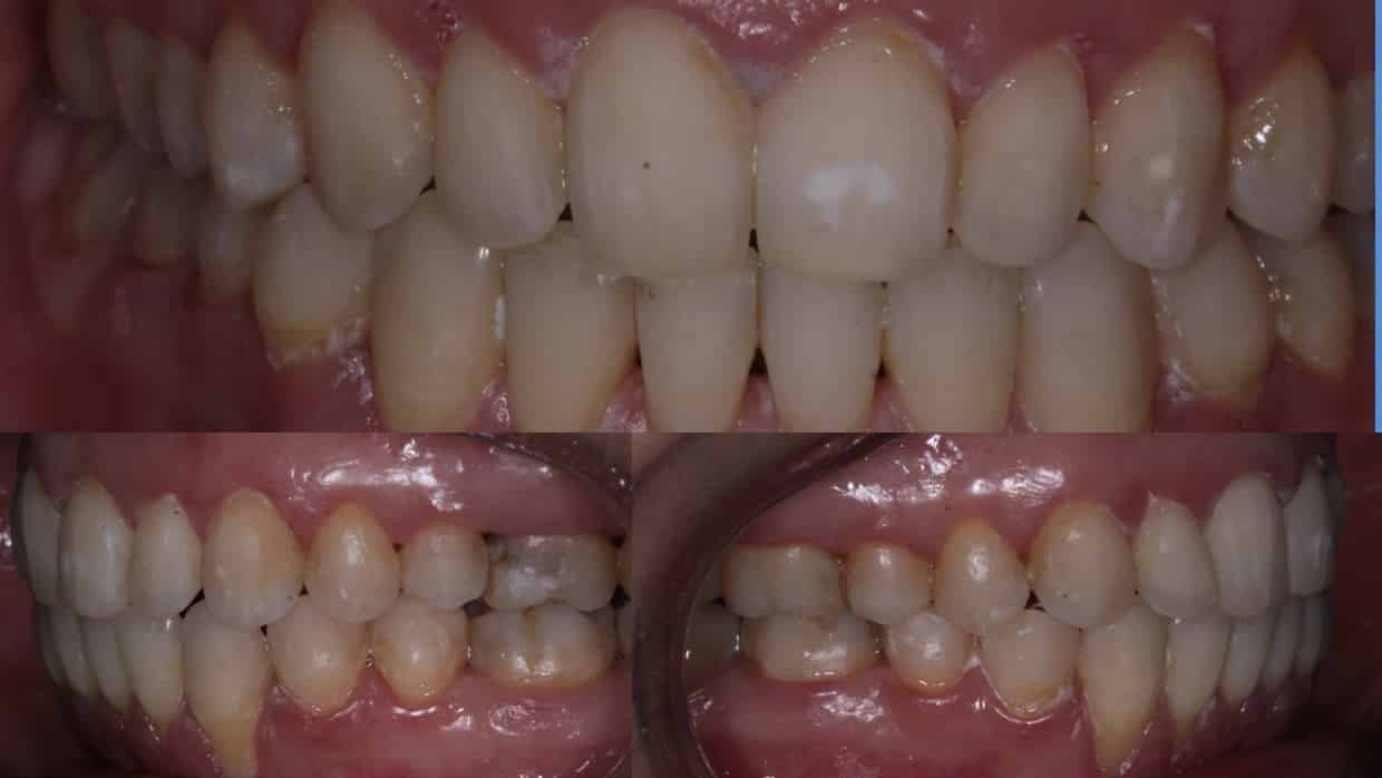 Ortodontia Damon System 151