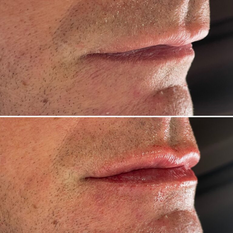 Botox - Ácido Hialurónico 20 Botox - Ácido Hialurónico 18