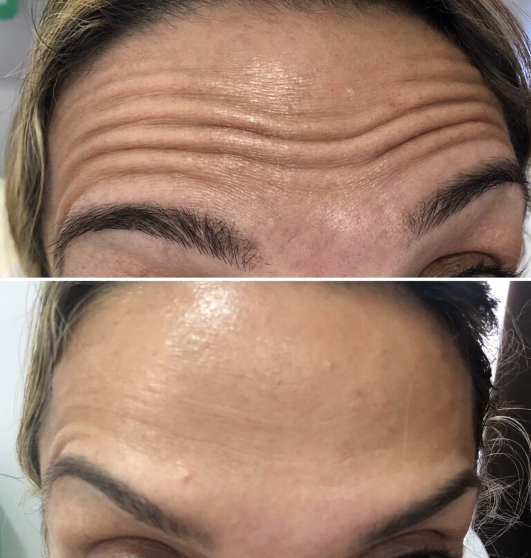 Botox - Ácido Hialurónico 15 Botox - Ácido Hialurónico 13