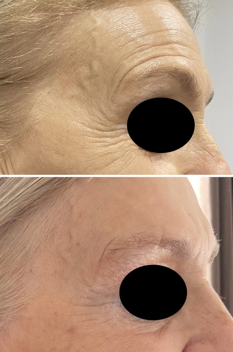 Botox - Ácido Hialurónico 14 Botox - Ácido Hialurónico 12