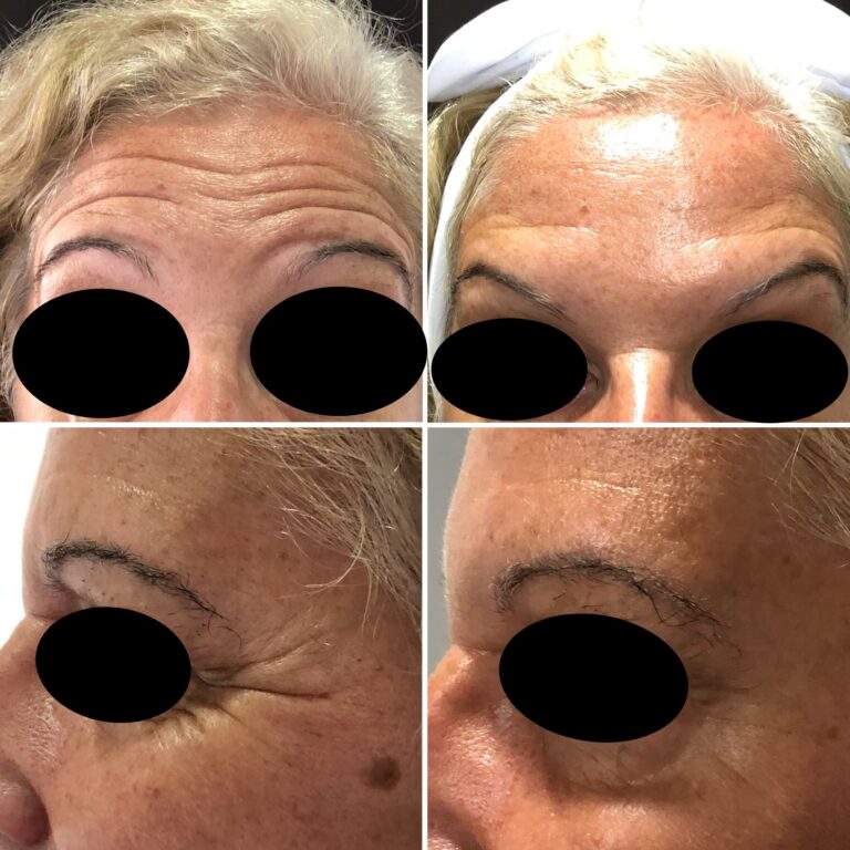 Botox - Ácido Hialurónico 16 Botox - Ácido Hialurónico 14
