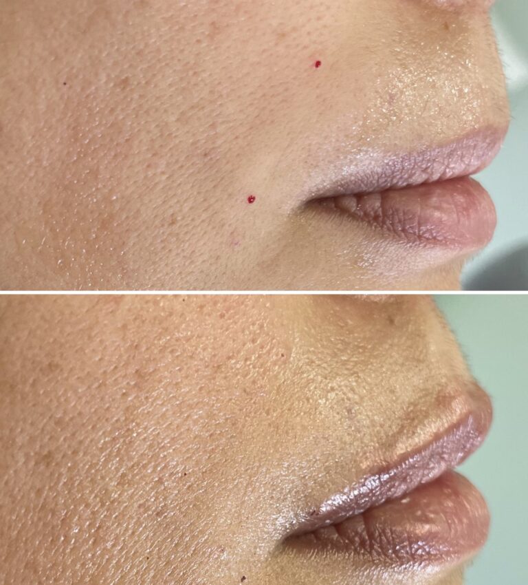 Botox - Ácido Hialurónico 7 Botox - Ácido Hialurónico 5