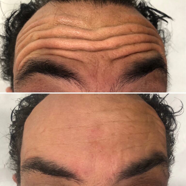 Botox - Ácido Hialurónico 19 Botox - Ácido Hialurónico 17