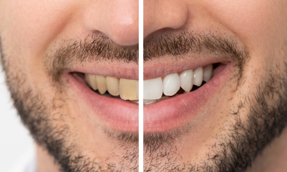 Galeria de Antes e Depois do Clareamento Dental