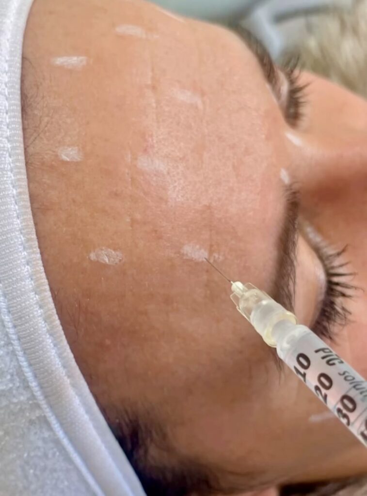Botox - Ácido Hialurónico 6 Botox - Ácido Hialurónico 4