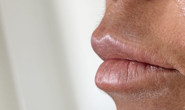 Botox - Ácido Hialurónico 22 Botox - Ácido Hialurónico 20