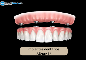 Implantes Dentários All-on-4®