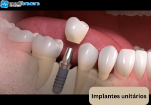 Implantes de Dente Único