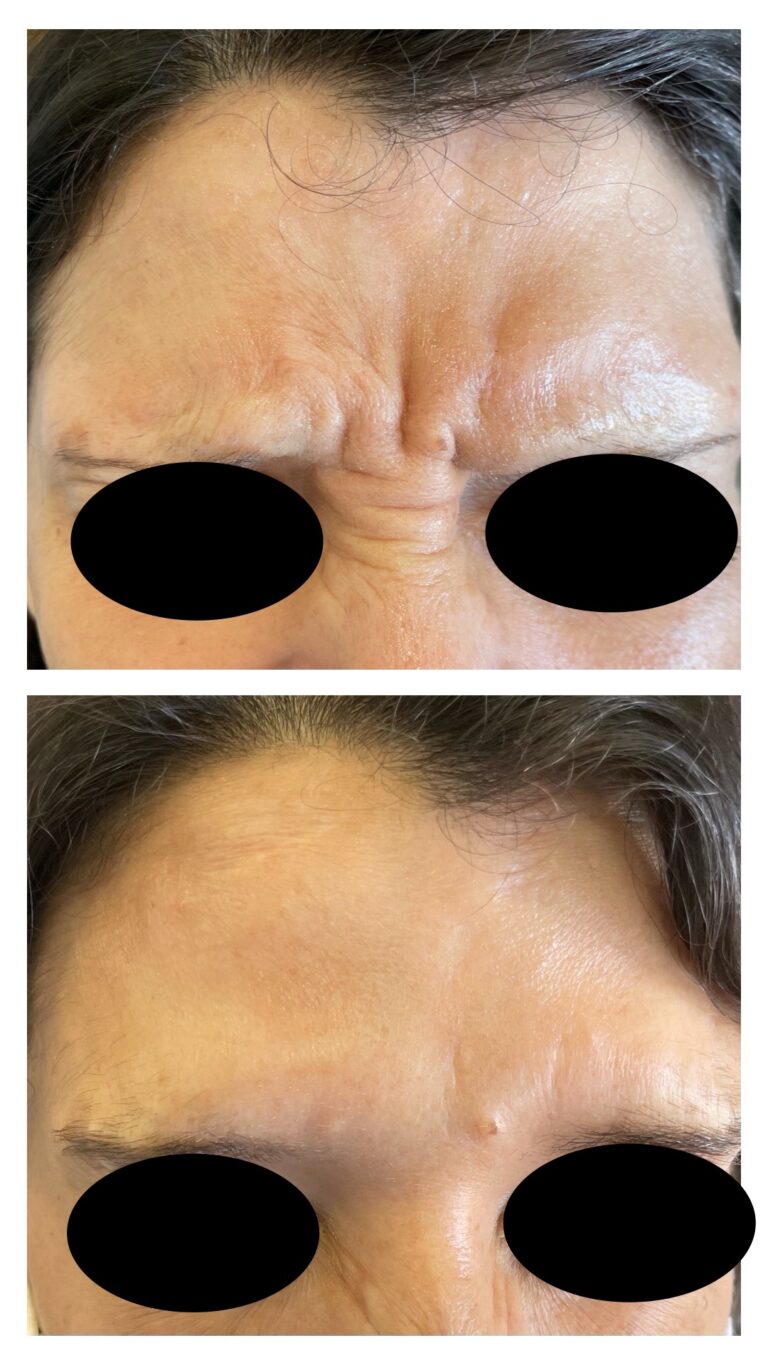 Botox - Ácido Hialurónico 18 Botox - Ácido Hialurónico 16