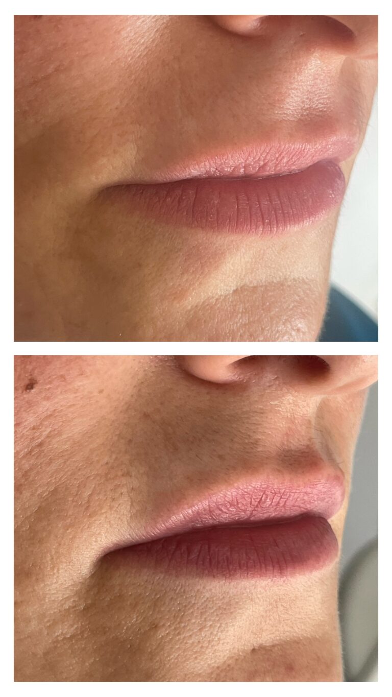 Botox - Ácido Hialurónico 10 Botox - Ácido Hialurónico 8