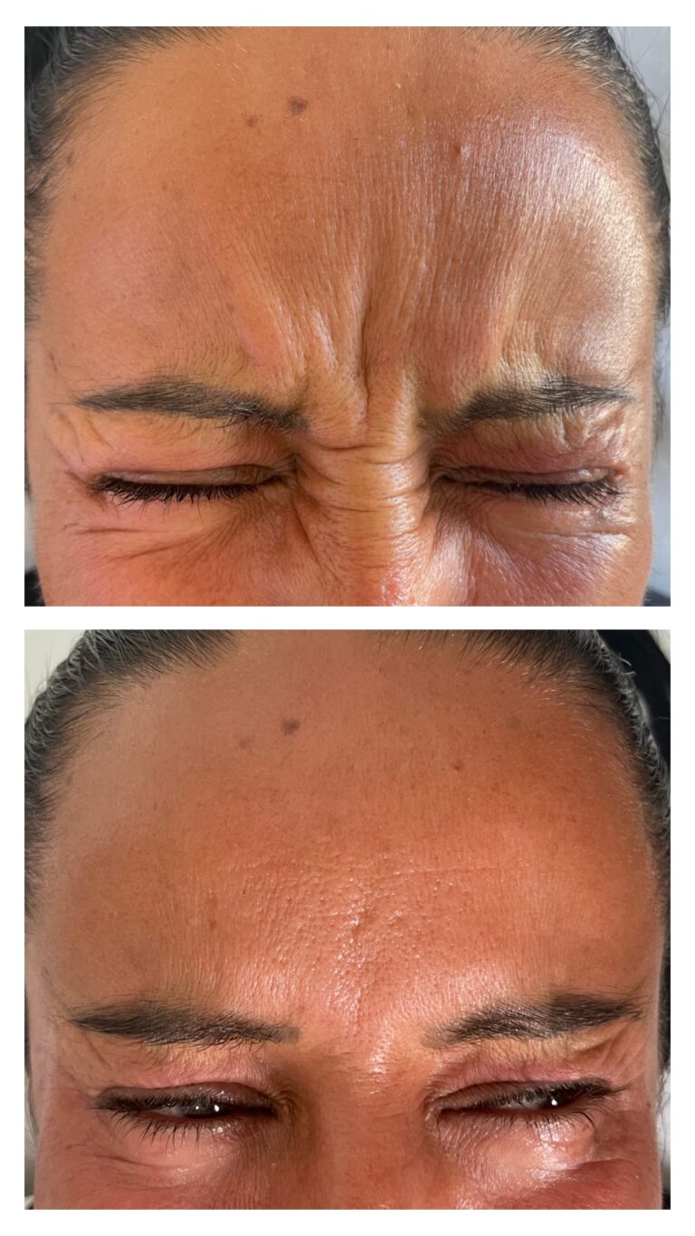 Botox - Ácido Hialurónico 21 Botox - Ácido Hialurónico 19