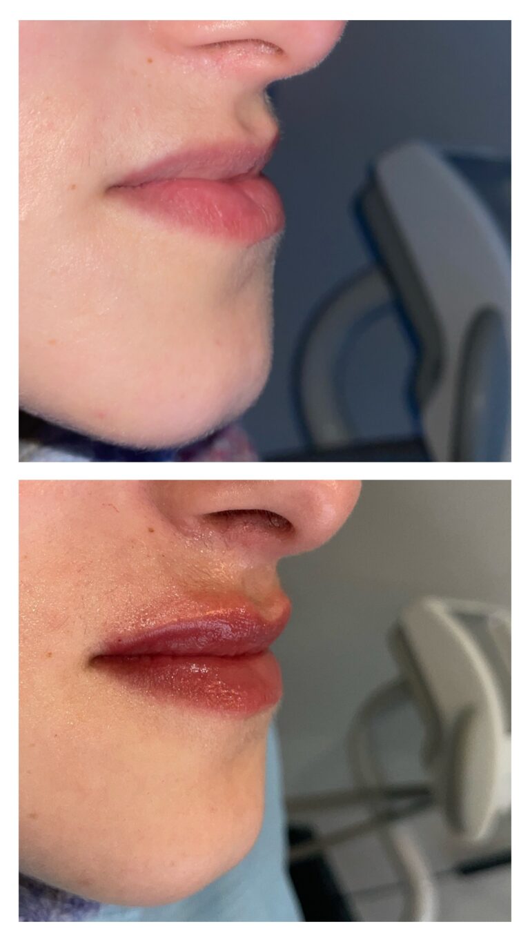 Botox - Ácido Hialurónico 8 Botox - Ácido Hialurónico 6