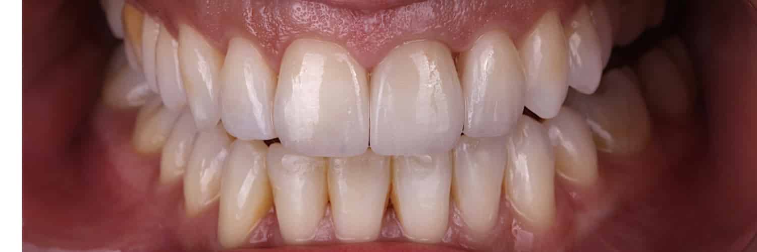 Facetas Dentárias Braga 19